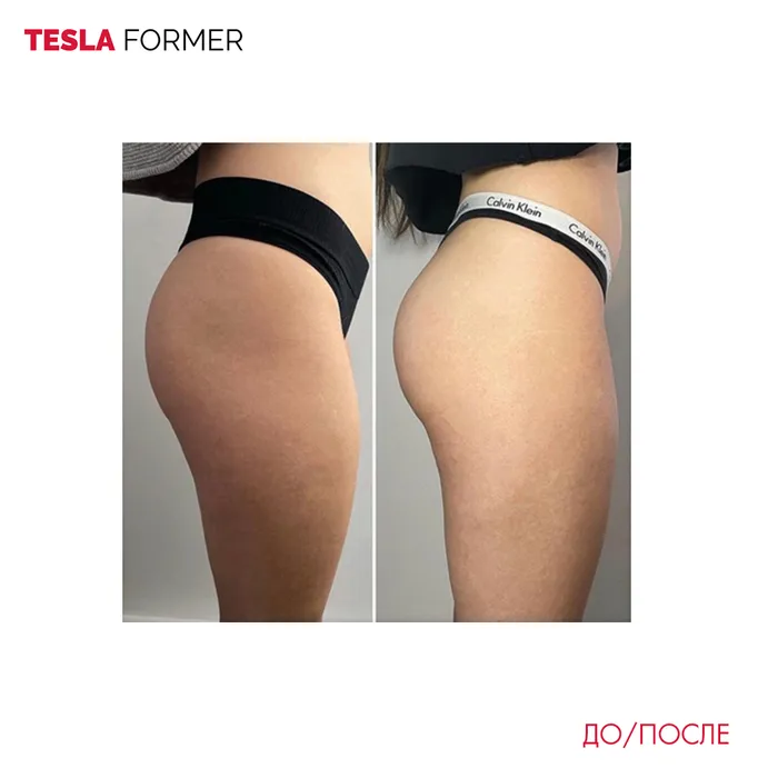 Tesla Former — аппаратная коррекция фигуры — пример 1