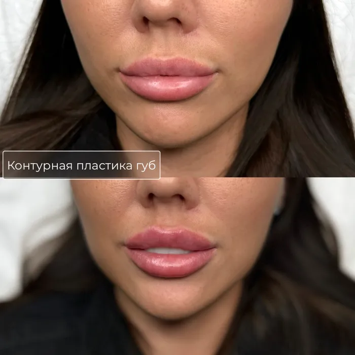 Увеличение и коррекция губ №7
