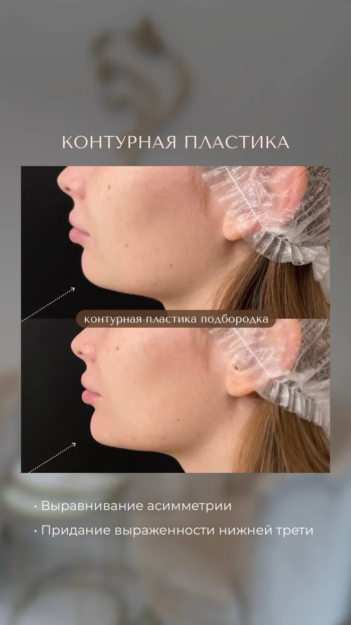 Контурная пластика №4