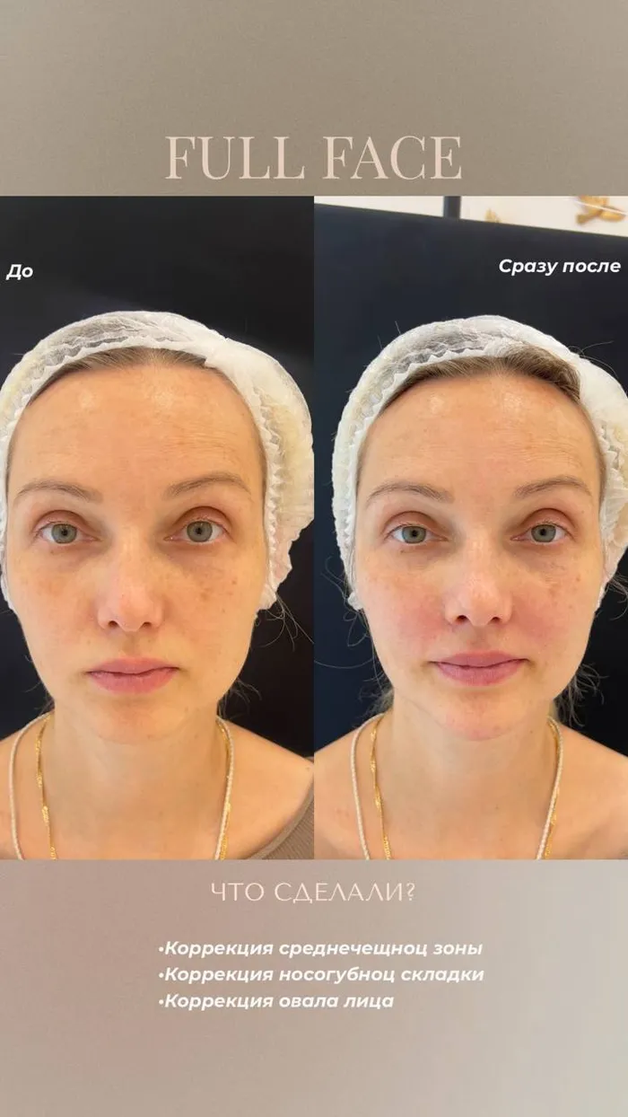 Контурная пластика №3